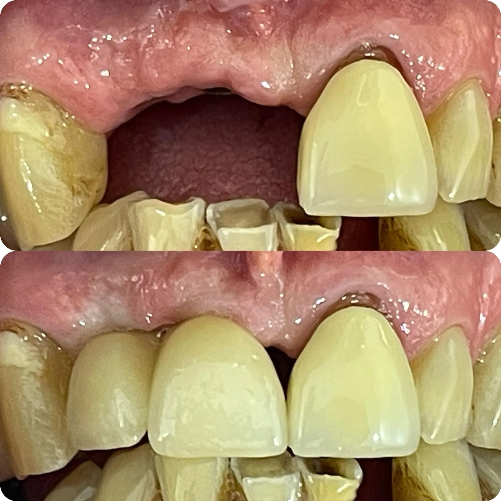 Before and after dental implant treatment