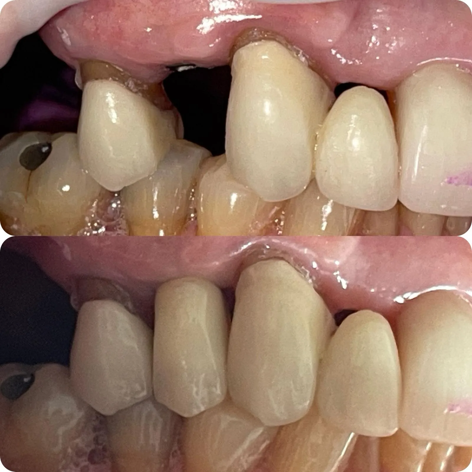 Before and after dental implant treatment
