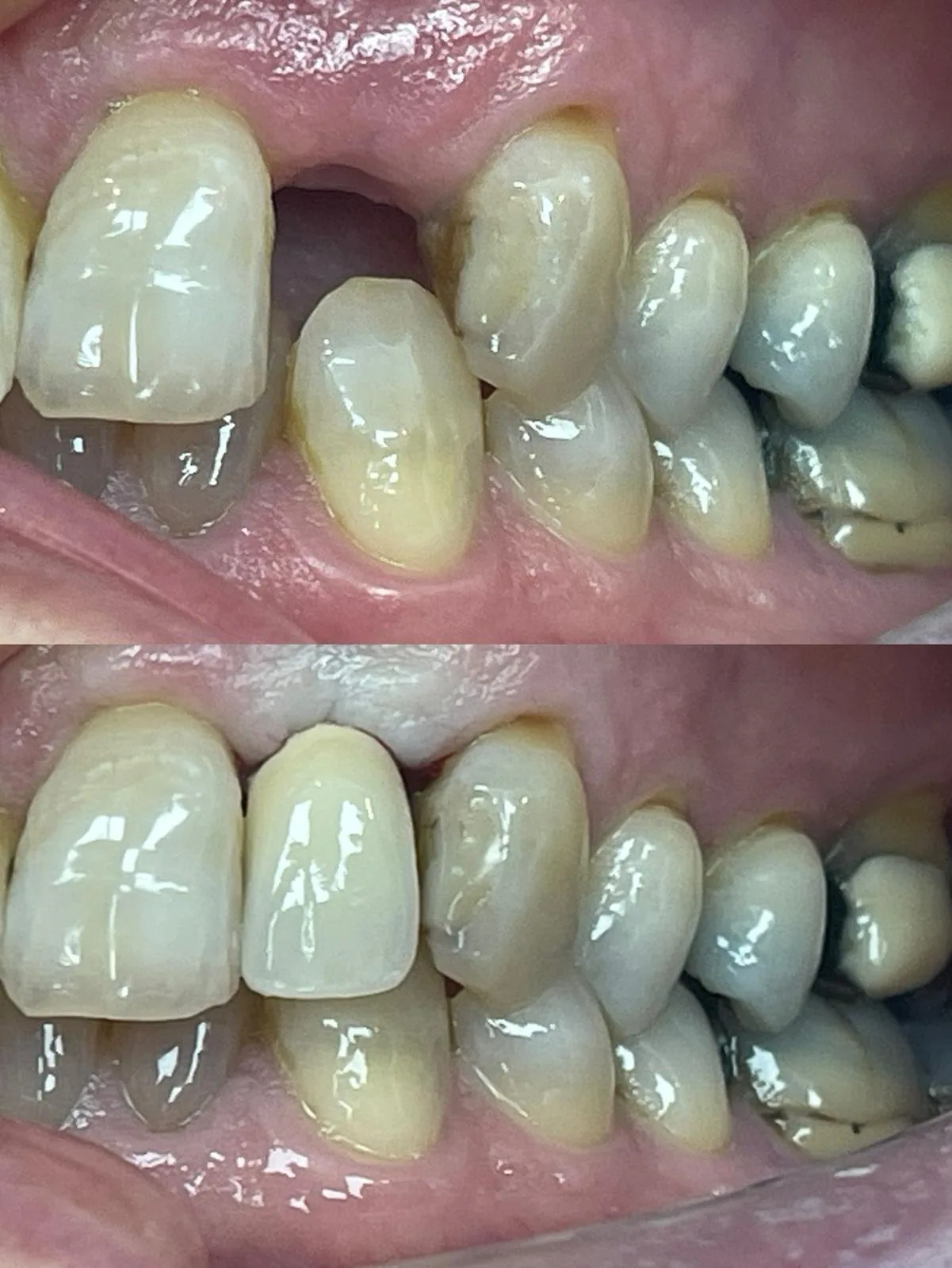 Before and after dental implant treatment